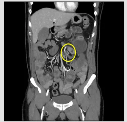 Figure 1. CT scan showing arterial thrombosis and bowel distension