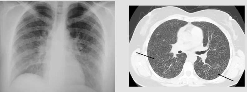 Figure 1. Chest X-ray of patient at admission to emergency department,  showing diffuse fine nodular opacities 