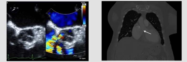 Figure 1. Transesophageal echocardiography in short axis  showing the ruptured  SVA creating an abnormal connection with the right atrium 