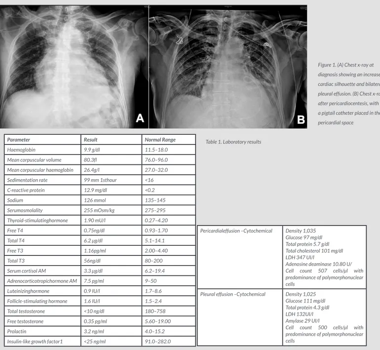 Figure 1. (A) Chest x-ray at  diagnosis showing an increased  cardiac silhouette and bilateral  pleural effusion