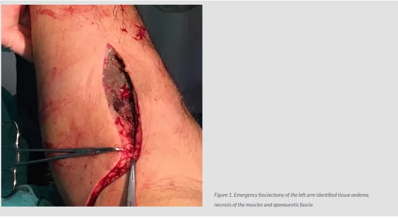 Figure 1. Emergency fasciectomy of the left arm identified tissue oedema,  necrosis of the muscles and aponeurotic fascia