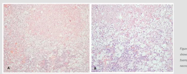 Figure 1. Photographs of histological findings  showing cellular infiltrates composed of  foamy histiocytes, with areas of coagulative  necrosis