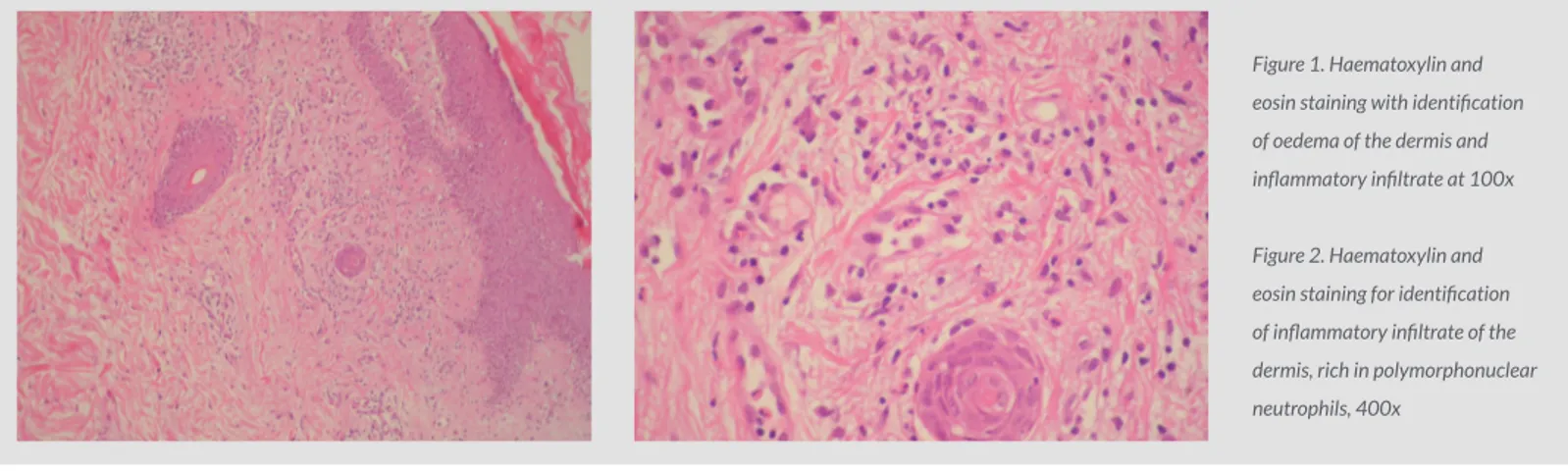 Figure 1. Haematoxylin and  eosin staining with identification  of oedema of the dermis and  inflammatory infiltrate at 100x