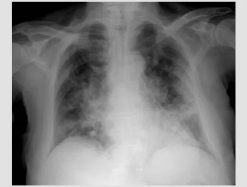 Figure 1. Chest x-ray showing bilateral pneumonia