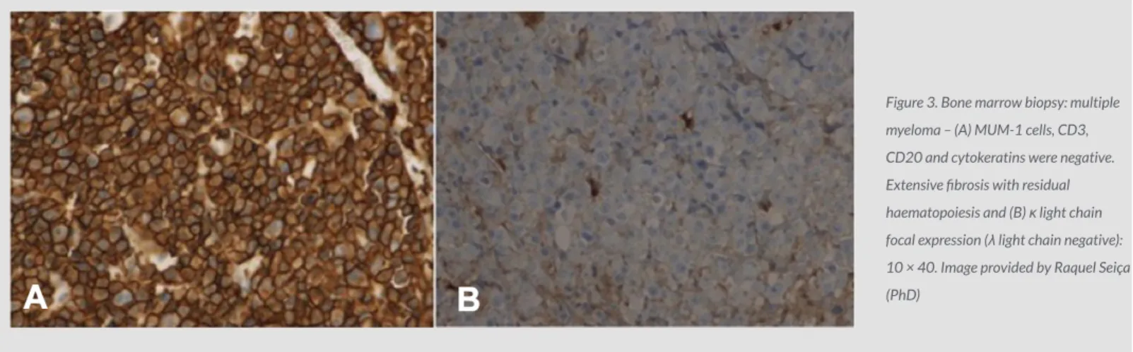 Figure 3. Bone marrow biopsy: multiple  myeloma – (A) MUM-1 cells, CD3,  CD20 and cytokeratins were negative