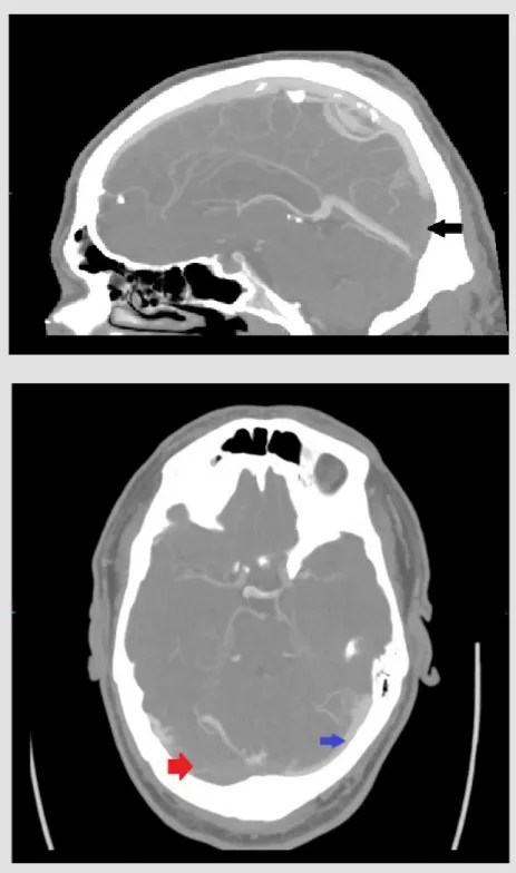 Figure 1. CT venogram (sagittal reconstruction – 4 mm maximum  intensity projection). Contrast in the sagittal sinus should extend  inferiorly to meet the straight sinus at the torcula/confluence of the  sinuses