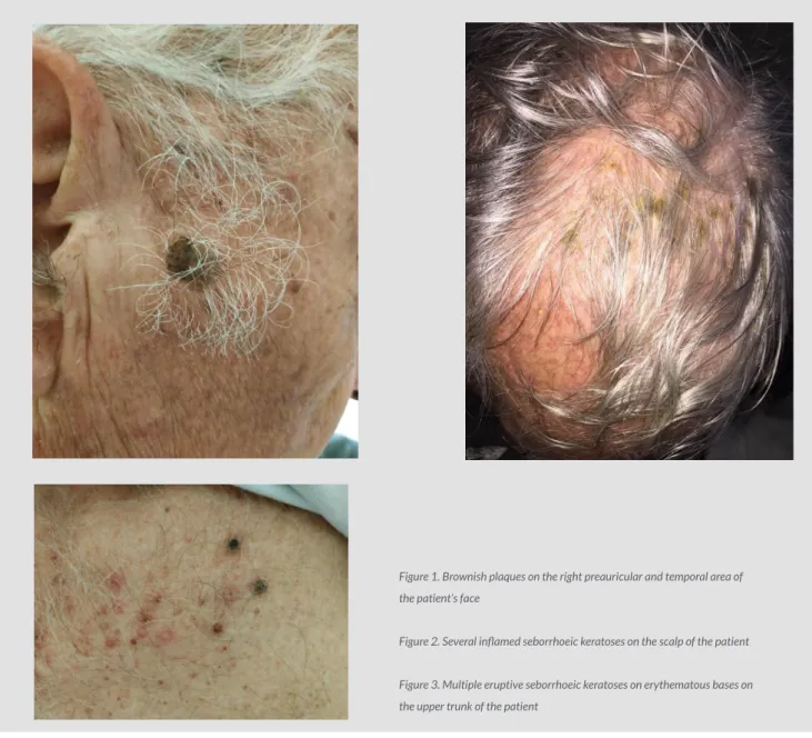 Figure 2. Several inflamed seborrhoeic keratoses on the scalp of the patient