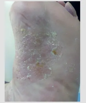 Figure 1. Dermatitis on the soles of the patient