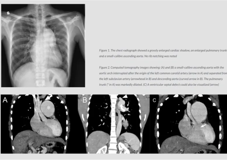 Figure 1. The chest radiograph showed a grossly enlarged cardiac shadow, an enlarged pulmonary trunk  and a small-calibre ascending aorta