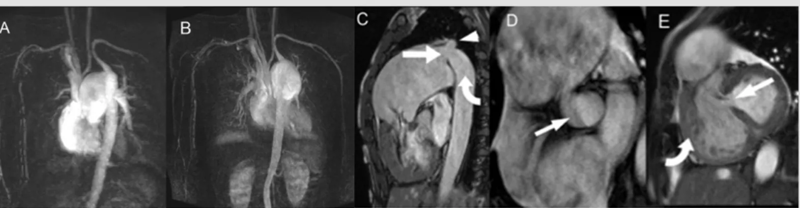 Figure 3. Magnetic resonance imaging (MRI). (A) and (B) Contrast-enhanced magnetic resonance angiography (MRA) with subtraction showing aortic interruption and an enlarged  pulmonary artery supplying the left subclavian artery and descending aorta via a pa