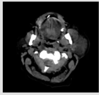 Figure 1. A neck scan showed an infiltration of the left parotid compartment with parotitis without any  detected collection  