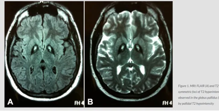Figure 1. MRI: FLAIR (A) and T2 (B). Bilateral,  symmetric foci of T2 hyperintensity were  observed in the globus pallidus (GP), surrounded  by pallidal T2 hypointensity