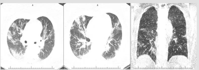 Figure 3. Ultra-low-dose CT images reveal multifocal ground glass opacities with consolidation, suggestive for SARS-CoV-2