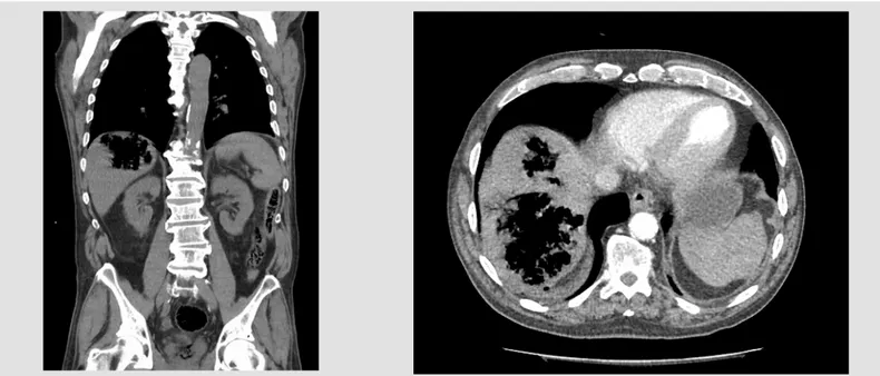 Figure 2. CT scan of the abdomen with contrast in axial view showing two areas with gas  within the right lobe of the liver
