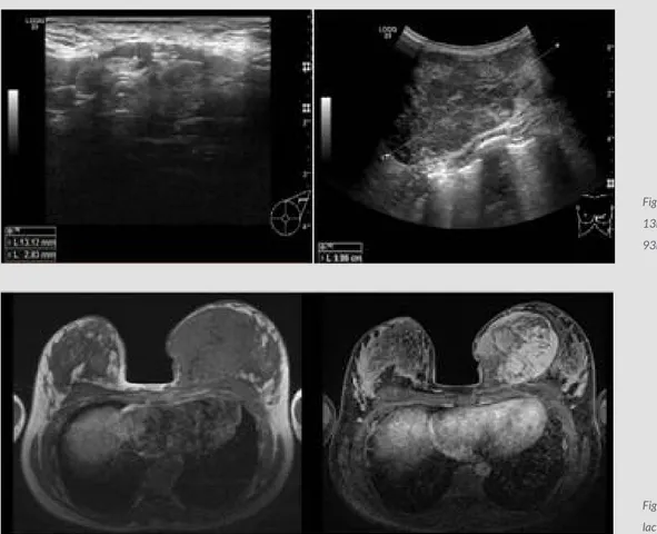 Figure 1. Left breast ultrasound scan showing a  13mm lesion at initial presentation (left) and a  93mm lesion during pregnancy (right)
