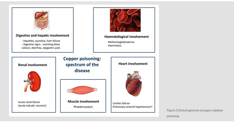 Figure 2.Clinical spectrum of copper sulphate  poisoning