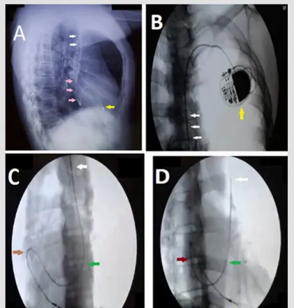 Figure 1. Imaging of single chamber VVI PPM in the following views.