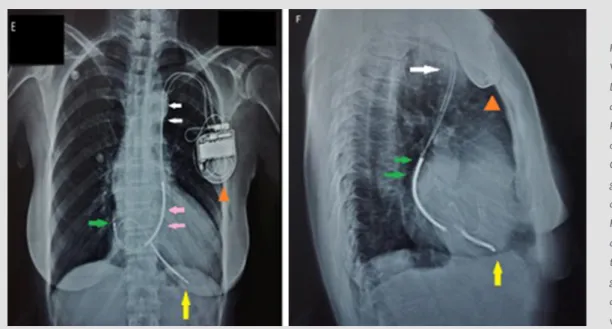 Figure 2. Case 2 Imaging of single chamber  VVI PPM in the following views.