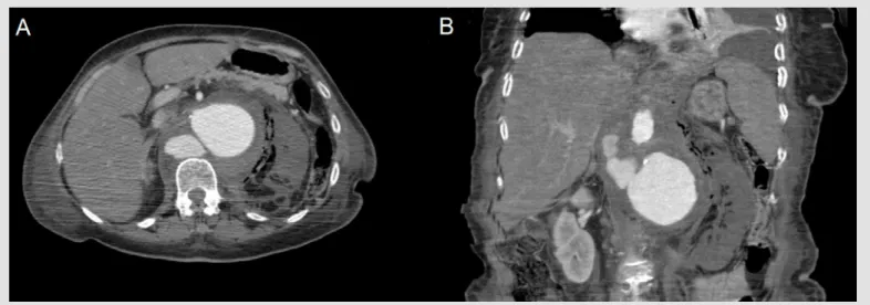 Figure 1. CT images (A and B) after intravenous iodinated contrast showing an abdominal aortic aneurysm with two other sacs corresponding to organised haemorrhagic leaks  and a left kidney with no contrast enhancement