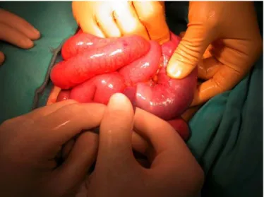 Fig. 1. Manual resolution of bowel intussusception during the surgical procedure. 