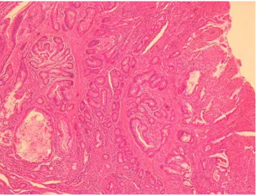 Fig. 3. Hyperplastic polyp epithelium is separated by branching bundles of smooth muscle