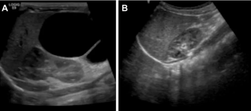 Figure 3 (A) Pre-treatment longitudinal US scan shows a cystic lesion with an internal septum, anteriorly to the right kidney
