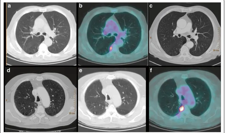 Figure 1 The undetectable nodule. 18 F-FDG PET-CT (June 2010): CT (a) and fused (b) axial images