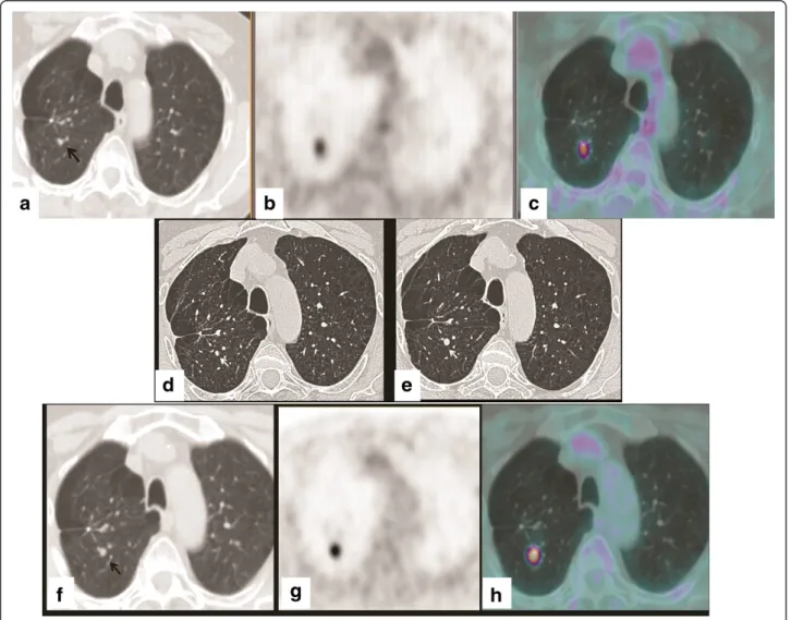 Figure 2 The misinterpreted nodule. 18 F-FDG PET-CT (June 2009): CT (a), PET (b), and fused (c) axial images
