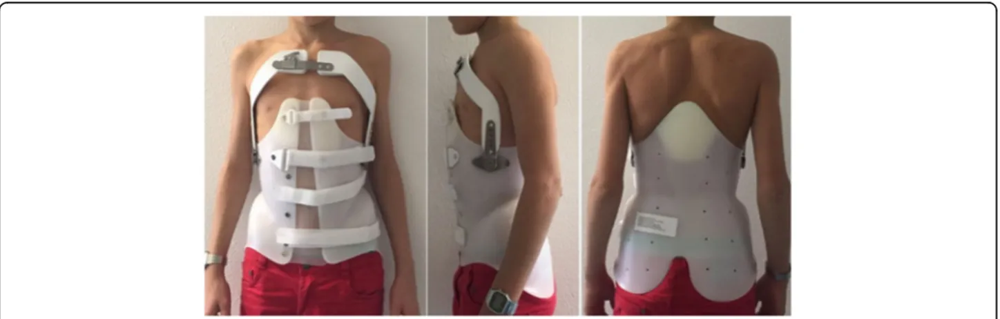 Fig. 1 The anti-gravity brace used for the treatment of Scheuermann ’s kyphosis