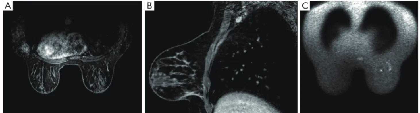 Figure 2 In the same patient we observed a complete disappearance of the lesion after chemotherapy on both axial (A) and sagittal  (B) 3D-FSPGR T1-weighted with fat suppression and contrast media injection images