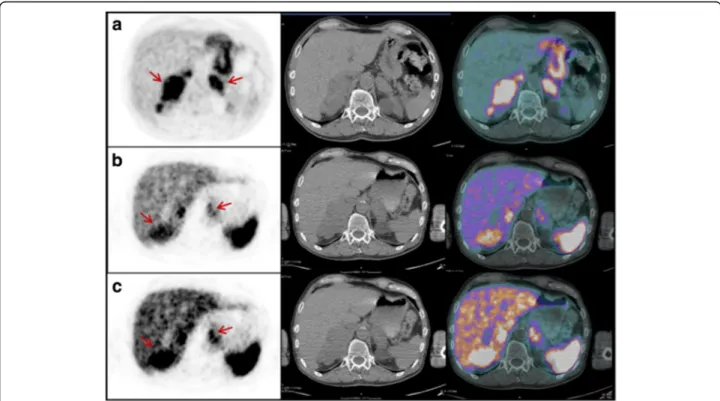 Fig. 2 PET/CT images performed for re-staging in patient #14. Transaxial 18 F-FDG (a) and 68 Ga-somatostatin analogs (b, c) at different intensity levels