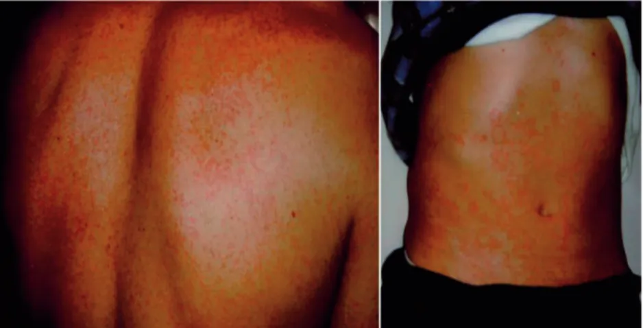 Fig. 1. The typical rash of the SS, which corresponds to a neutrophilic urticarial dermatosis: red eruptions consisting of flat macules are visible on the back and abdomen.