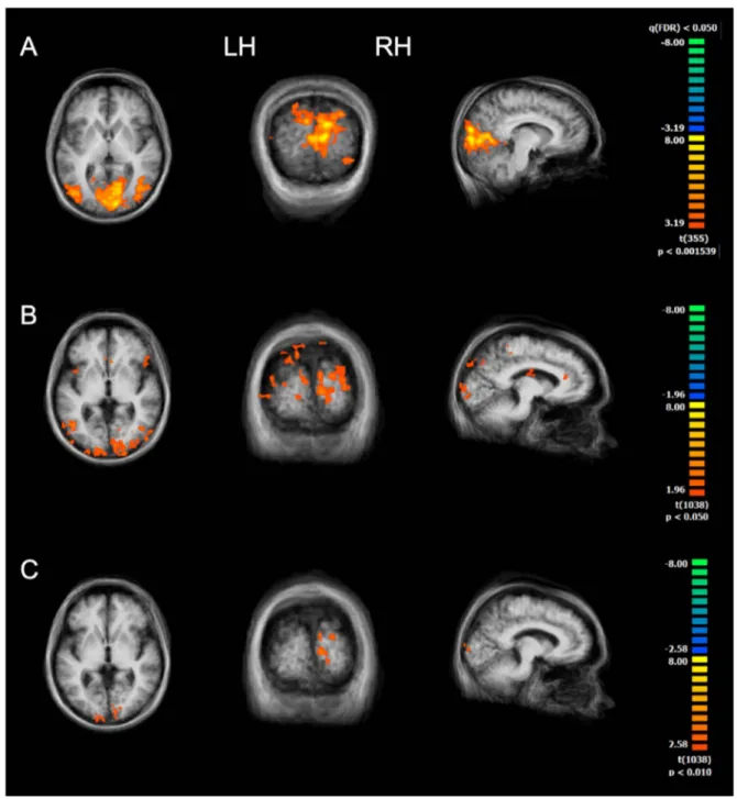 Figure 5. BOLD response to flashing lights. Cortical activity elicited by flashing stimuli in (A) four sighted subjects and in (B, C) eight RP patients (B and C come from the same data set but at different thresholds)