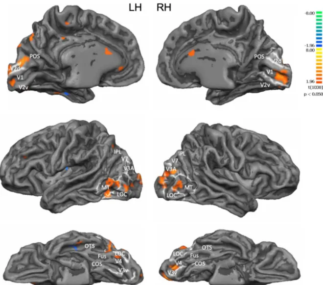 Figure 6. BOLD response to flashing lights in RP patients. Results from the multistudy, multisubject GLM when displaying the activation map onto a surface-based aligned brain of a seeing subject who underwent standard retinotopic mapping