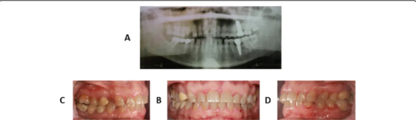 Fig. 2 Clinical records of the mother ’s proband: panoramic radiographic analysis (a), intraoral frontal view (b), intraoral right lateral view (c), intraoral left lateral view (d)