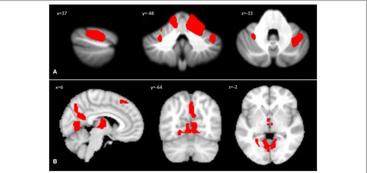 FIGURE 1 | (A) Between-group voxel-based comparison of cerebellar GM volumes. Cerebellar regions showing patterns of significantly reduced GM in SPG7 compared to HS are reported and superimposed on sagittal (x = 37), coronal (y = −48), and axial (z = −33) 