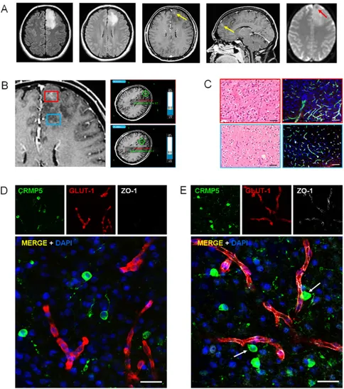 Figure 2. Perivascular invasion and disruption of blood–brain barrier (BBB) in anaplastic glioma