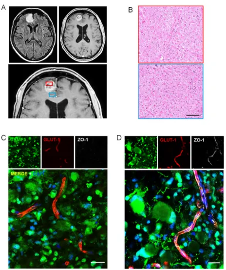 Figure 4. Perivascular invasion and disruption of BBB in glioblastoma. (A), FLAIR T2–weighted (top  left panel) and Gd enhanced T1-weighted (top right and lower panels) MR images showing a small  left frontal tumor that shows a hyperintense signal in the F