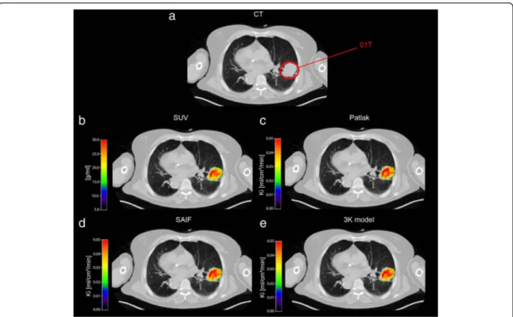 Fig. 3 Parametric maps of SUV and K i in a representative patient. Transaxial thoracic CT image: the primary lung cancer is highlighted by red circle (a)
