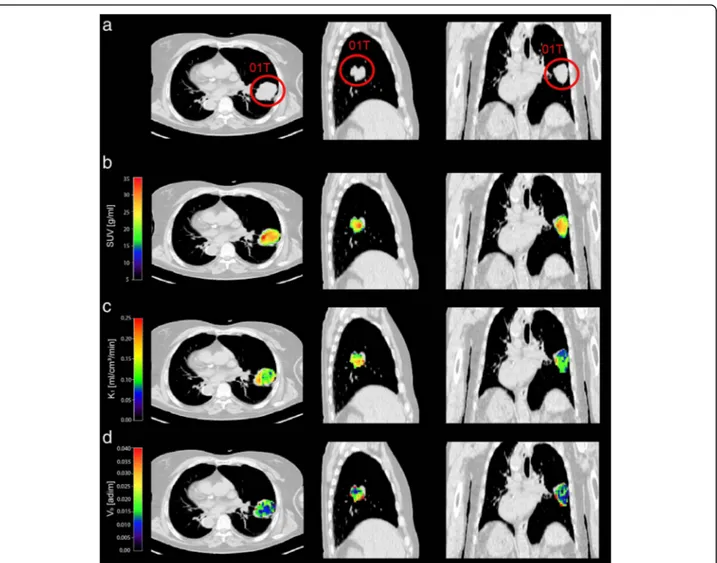 Fig. 4 Parametric maps of SUV, K 1 and V b in a representative patient. Transaxial, lateral and frontal views of thoracic CT image: the primary lung cancer is highlighted by red circle (a)