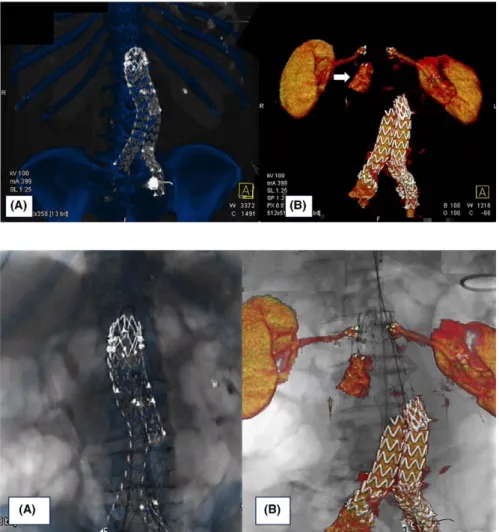 FIGURE 1  Bone and stent graft  scaffolding volume rendering (VR) (A). VR  of the type IA endoleak, renal arteries (B)
