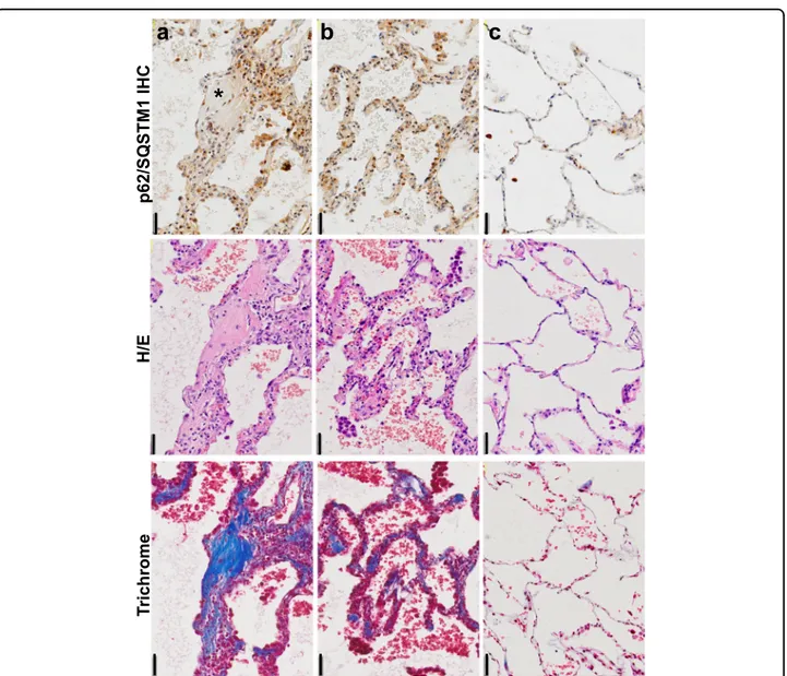 Fig. 1 p62/SQSTM1 is highly expressed in IPF ﬁbroblastic foci and epithelial cells of thickened alveoli septae where collagen deposition in the interstitium is also evident