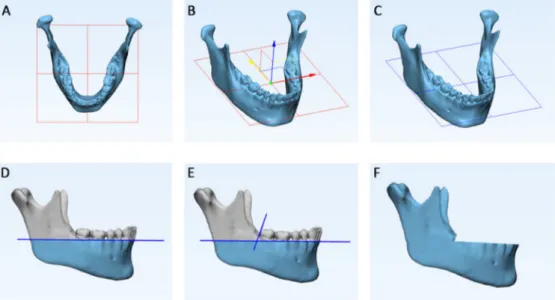 Figure 3. Each 3D mandibular model obtained from semi-automatic segmentation was superimposed  to its ground truth model (manual segmentation) in order to reliably remove alveolar processes and  teeth