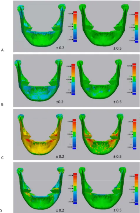 Figure 4. Surface-based deviation analysis between 3D mandibular models obtained with semi- semi-automatic segmentation and its ground truth model (manual segmentation)