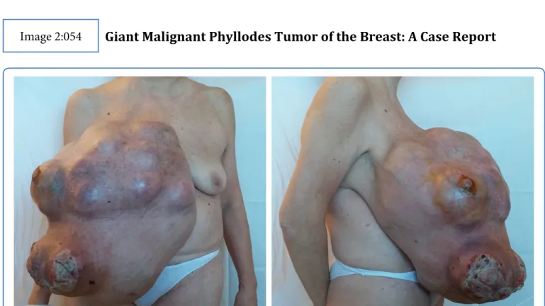 Figure 1: Pre-operative photograph shoving giant right breast mass of 43 × 40 cm with skin ulceration and severe disfigurement.