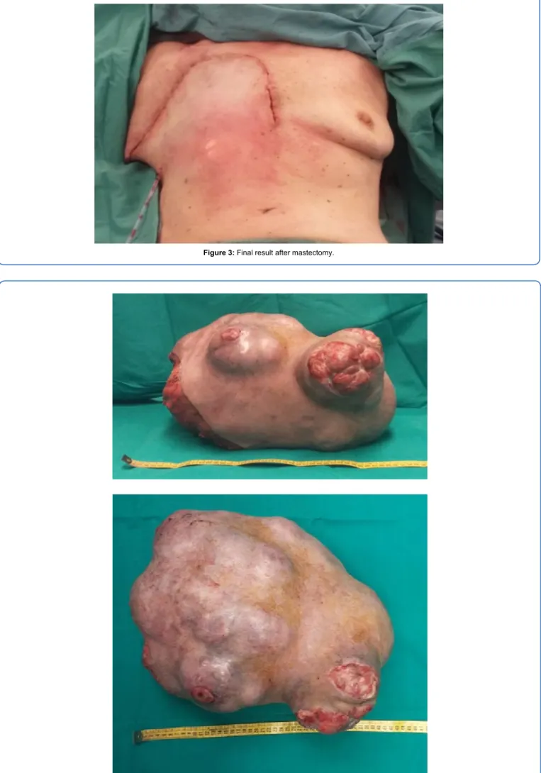Figure 3: Final result after mastectomy.