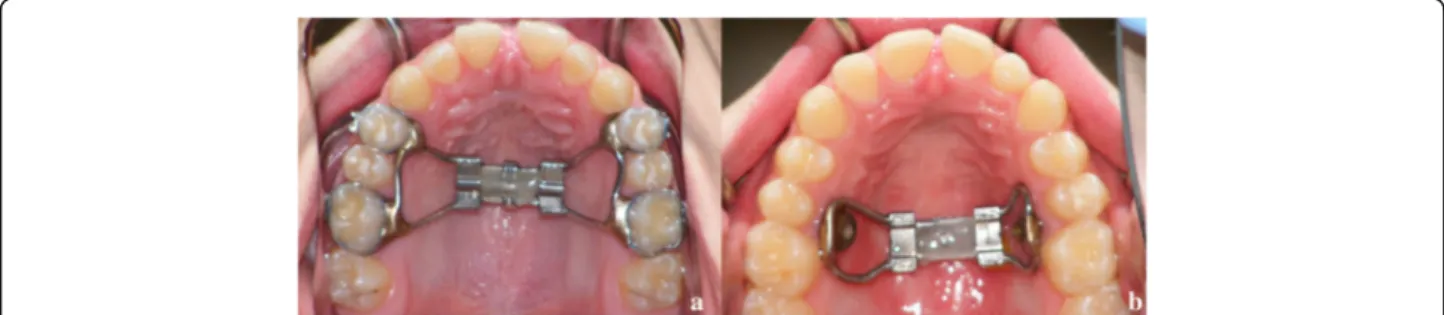 Fig. 1 Tooth-borne (a) and Bone-borne (b) palatal expander used in this study. See the interincisal diastema after maxillary expansion