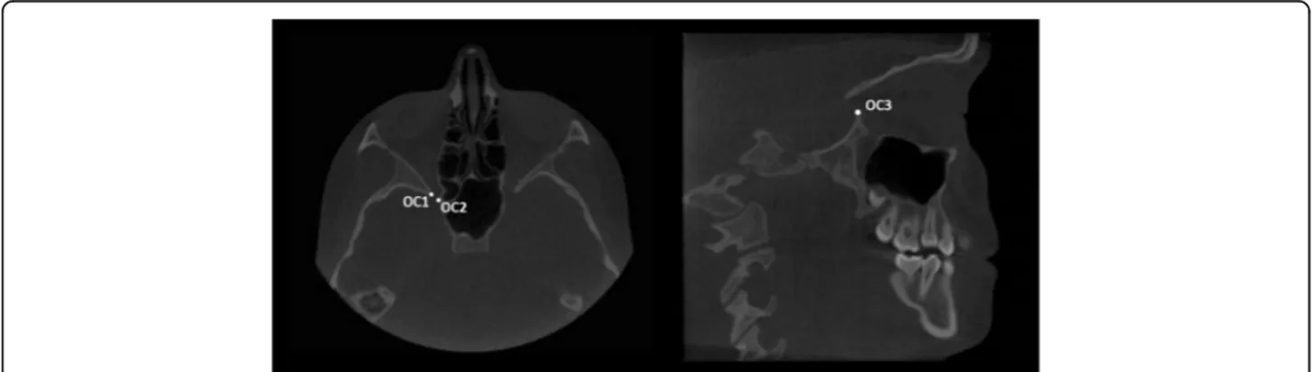 Fig. 5 The posterior plane was constructed by selecting the lateral (OC1) and medial (OC2) walls of the optic foramen taken at the most caudal axial view and the most cranial point of the lateral walls (OC3) of the optic foramen taken on the sagittal view