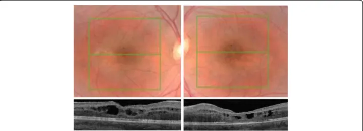 Fig. 1 Fundus photography and structural optical coherence tomography B scan of eyes affected by enhanced S-cone syndrome