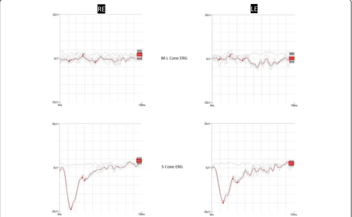 Fig. 2 Cone-mediated electroretinograms of the patient affected by enhanced S-cone syndrome